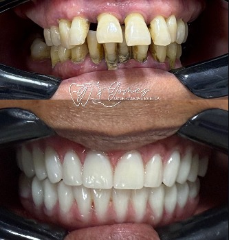 Caso real de reabilitação com implantes e prótese fixa, Gomes Odontologia & Estética