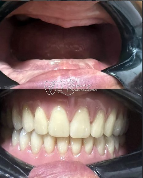 Antes e depois real de clareamento dental, Gomes Odontologia & Estética