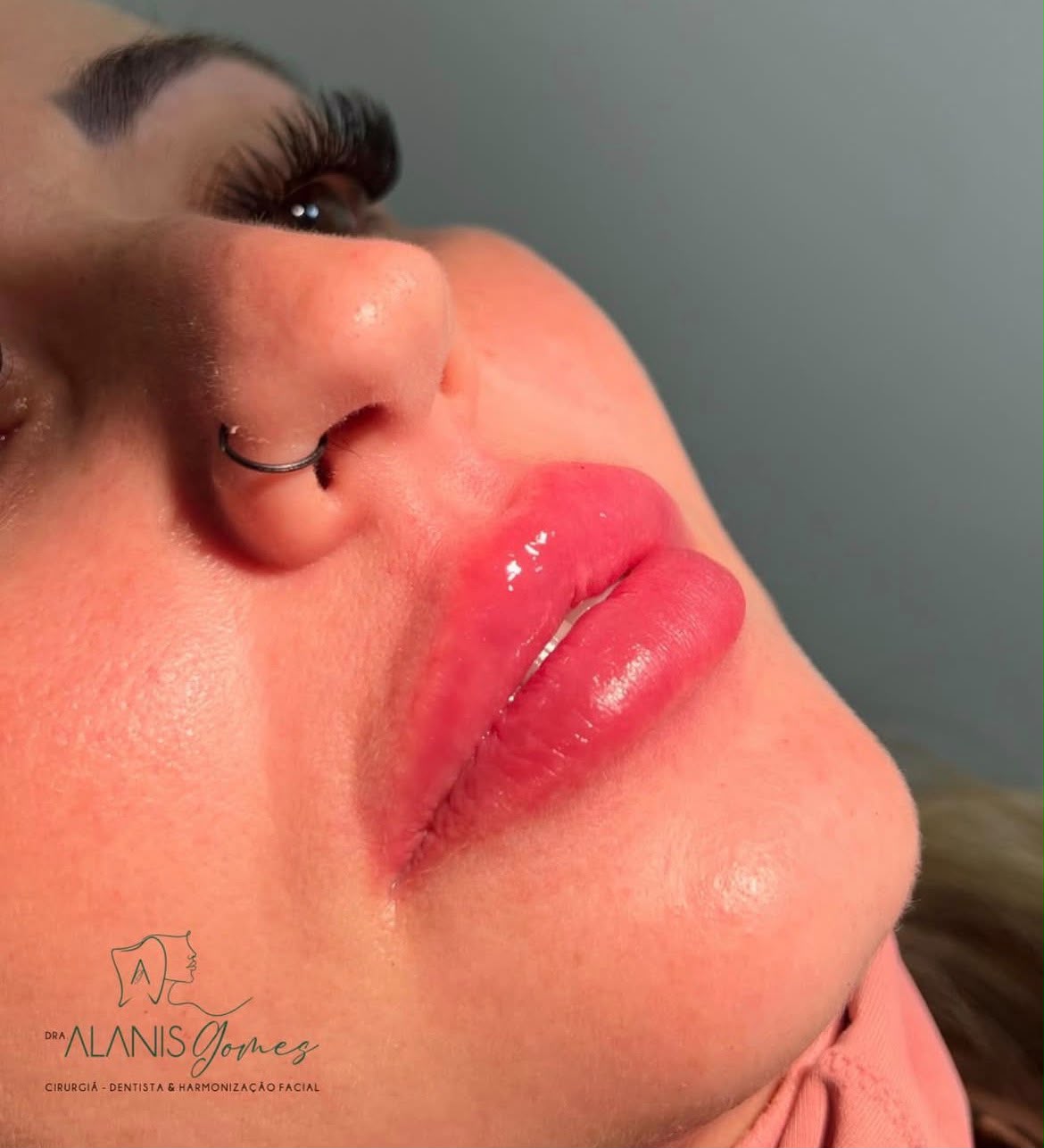 Resultado de harmonização facial, Gomes Odontologia & Estética