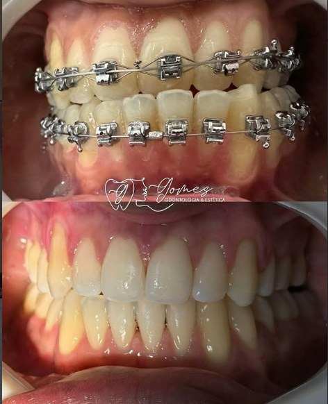 Antes e depois real de tratamento ortodôntico, Gomes Odontologia & Estética