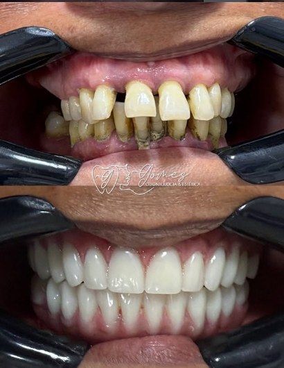 Antes e depois real de reabilitação dentária