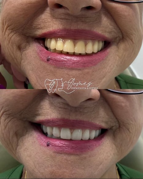 Antes e depois real de reabilitação protética