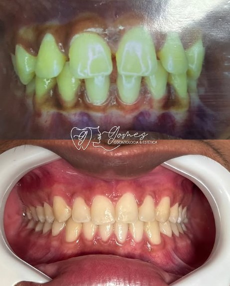 Antes e depois real de clareamento dental