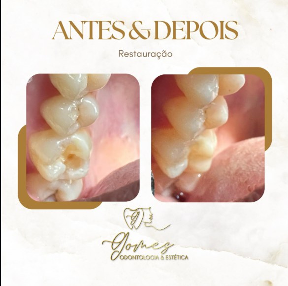 Antes e depois real de restauração dentária